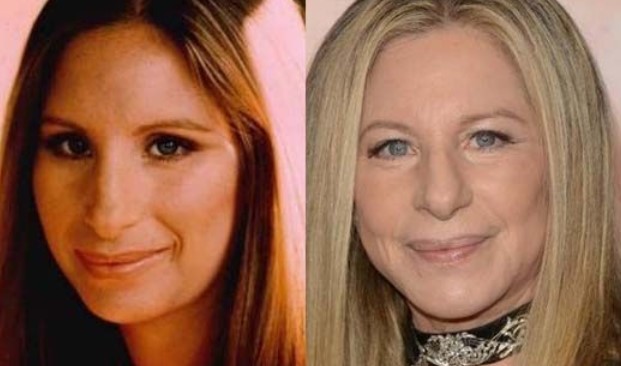 Barbra Streisand Plastic Surgery