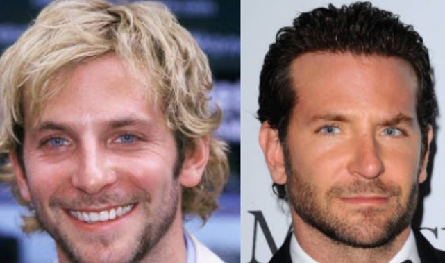 Bradley Cooper Plastic Surgery