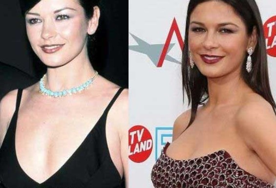 Catherine Zeta Jones Plastic Surgery