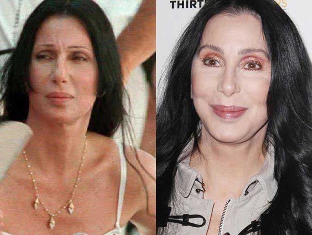 Cher Plastic Surgery