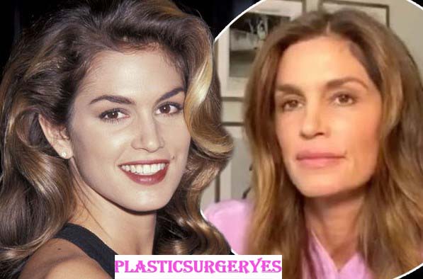 Cindy Crawford Plastic Surgery