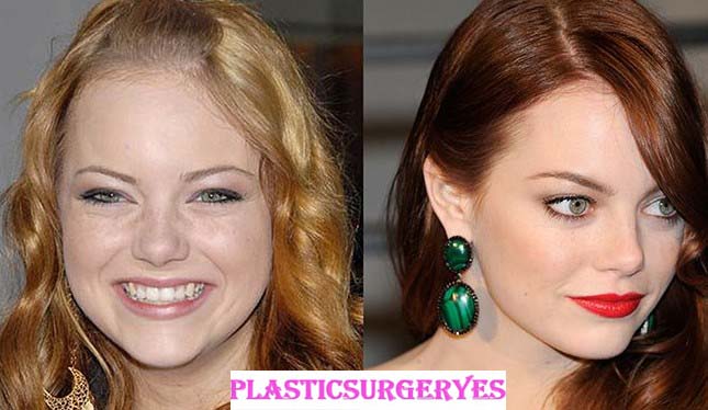 Emma Stone Plastic Surgery Nose Job