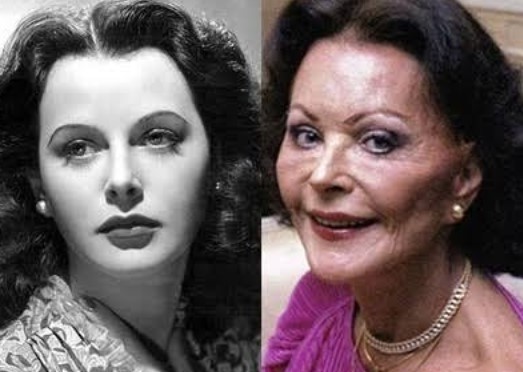 Hedy Lamarr Plastic Surgery