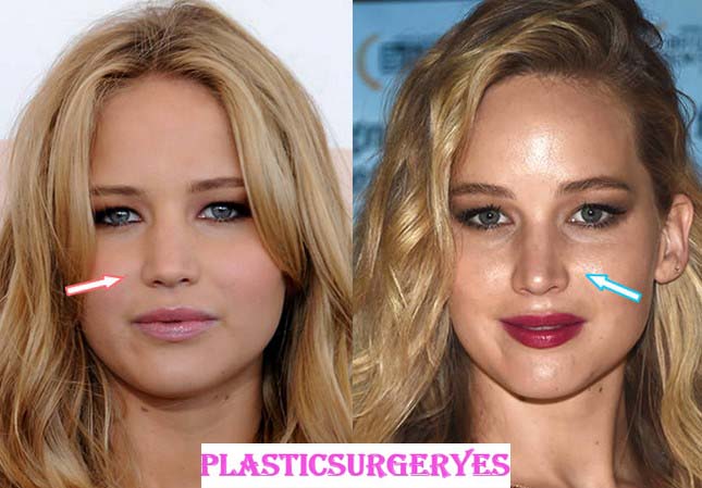 Jennifer Lawrence Plastic Surgery