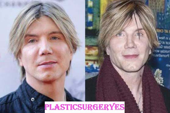 John Rzeznik Plastic Surgery