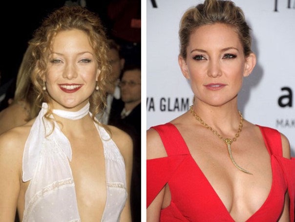 Kate Hudson Boob Job Nose Job Plastic Surgery