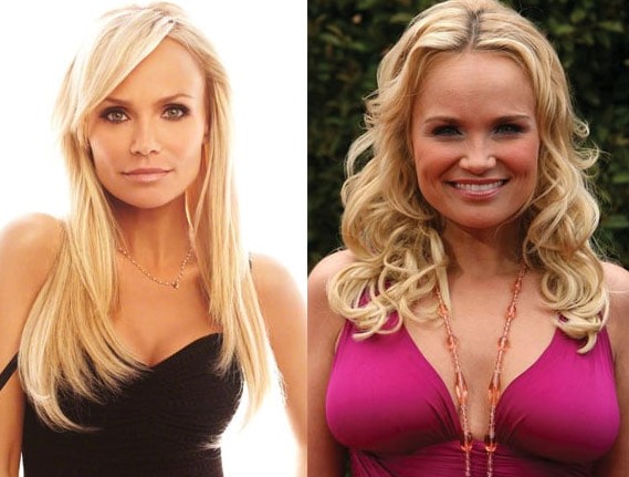 Kristin Chenoweth Plastic Surgery