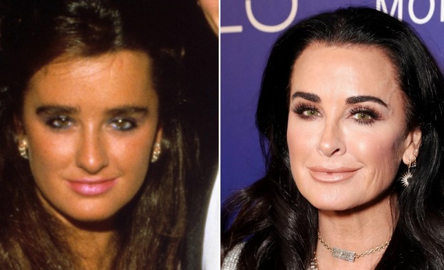 Kyle Richards Plastic Surgery