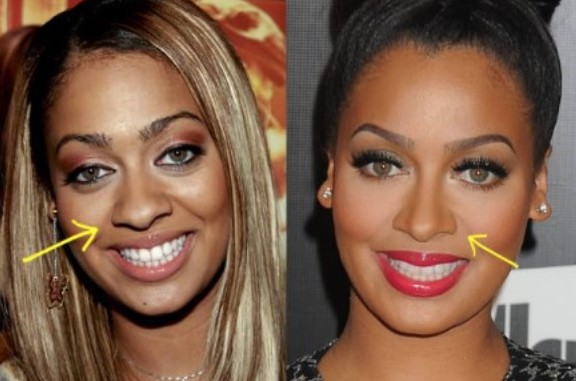 Lala Anthony Plastic Surgery Nose Job