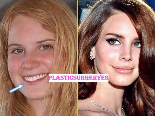 Lana Del Rey Plastic Surgery