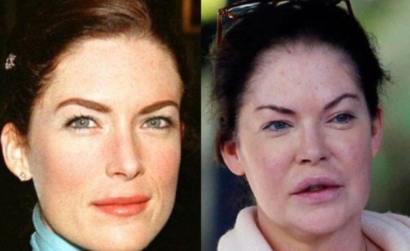 Lara Flynn Boyle Plastic Surgery