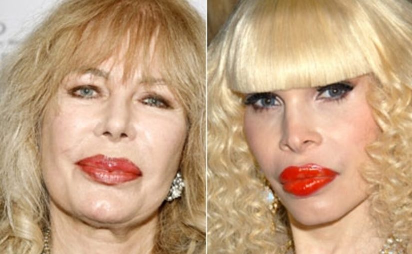 Loretta Swit plastic surgery