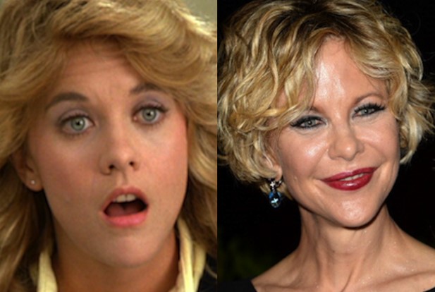 Meg Ryan Plastic Surgery