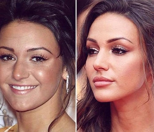 Michelle Keegan Plastic Surgery Nose Job