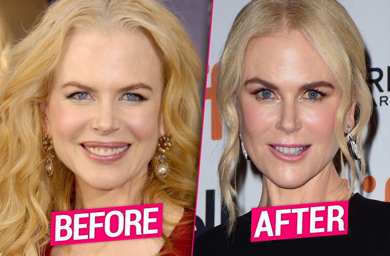 Nicole Kidman plastic surgery - before and after