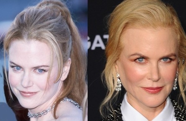 Nicole Kidman Plastic Surgery