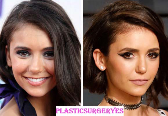 Nina Dobrev Plastic Surgery Nose Job