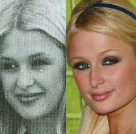 Paris Hilton Plastic Surgery Nose Job