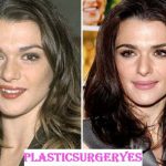 Rachel Weisz Plastic Surgery