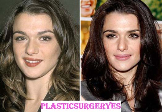 Rachel Weisz Plastic Surgery