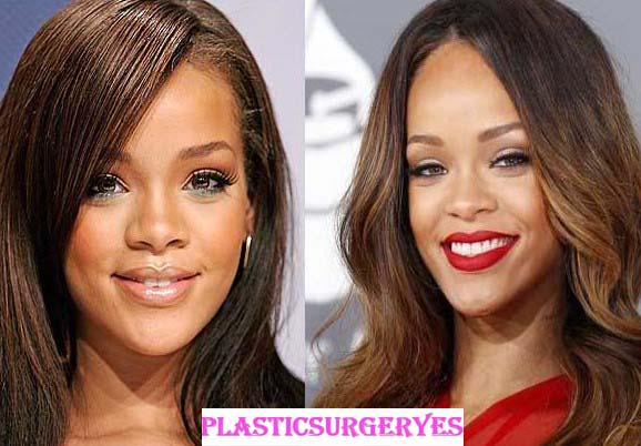 Rihanna Plastic Surgery