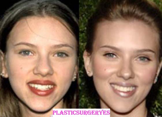 Scarlett Johansson Plastic Surgery