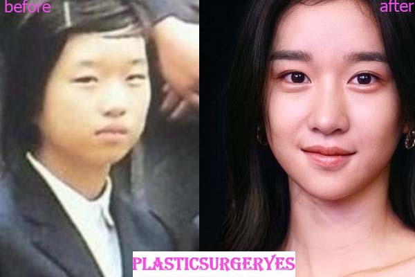 Seo Ye Ji Plastic Surgery