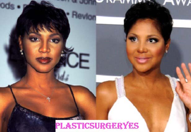 Toni Braxton Plastic Surgery