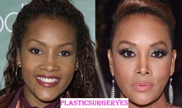 Vivica Fox Plastic Surgery