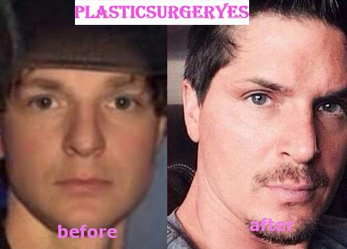 Zak Bagans Nose Job Plastic Surgery